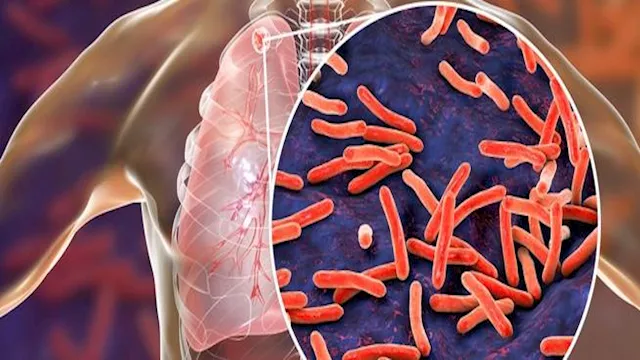 الأكثر فتكًا بالعالم.. الصحة العالمية: وفاة أكثر من مليون شخص بمرض السل... 1 2022 10 25 12 9 34 454